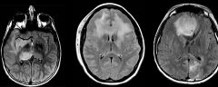 Three MRI Scans