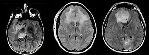 Gliomatosis Cerebri | Gliomatosis Cerebri International ...